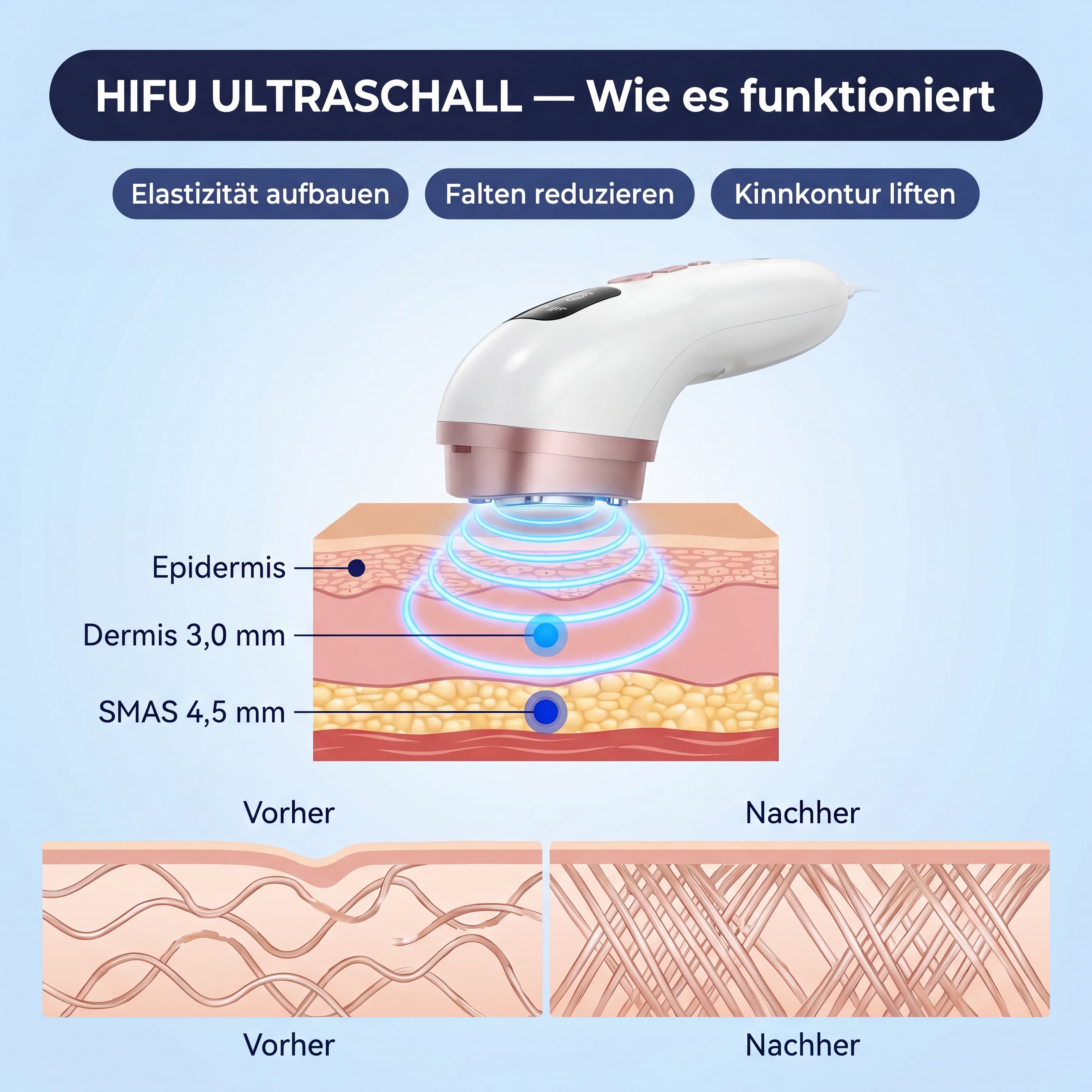 VENO HIFU
